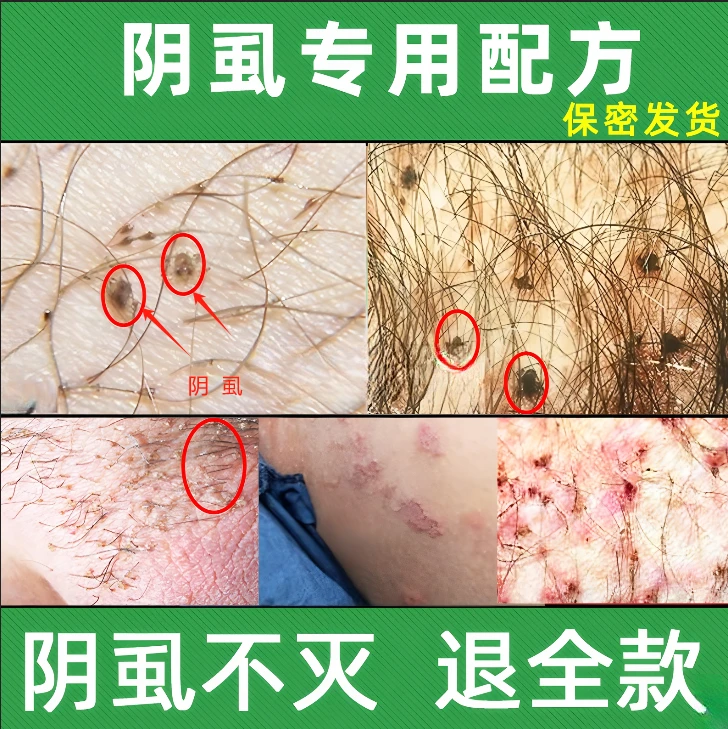【直播间同款】百部酊去虱净温和不伤发肤虱子虱卵一扫光成人阴用