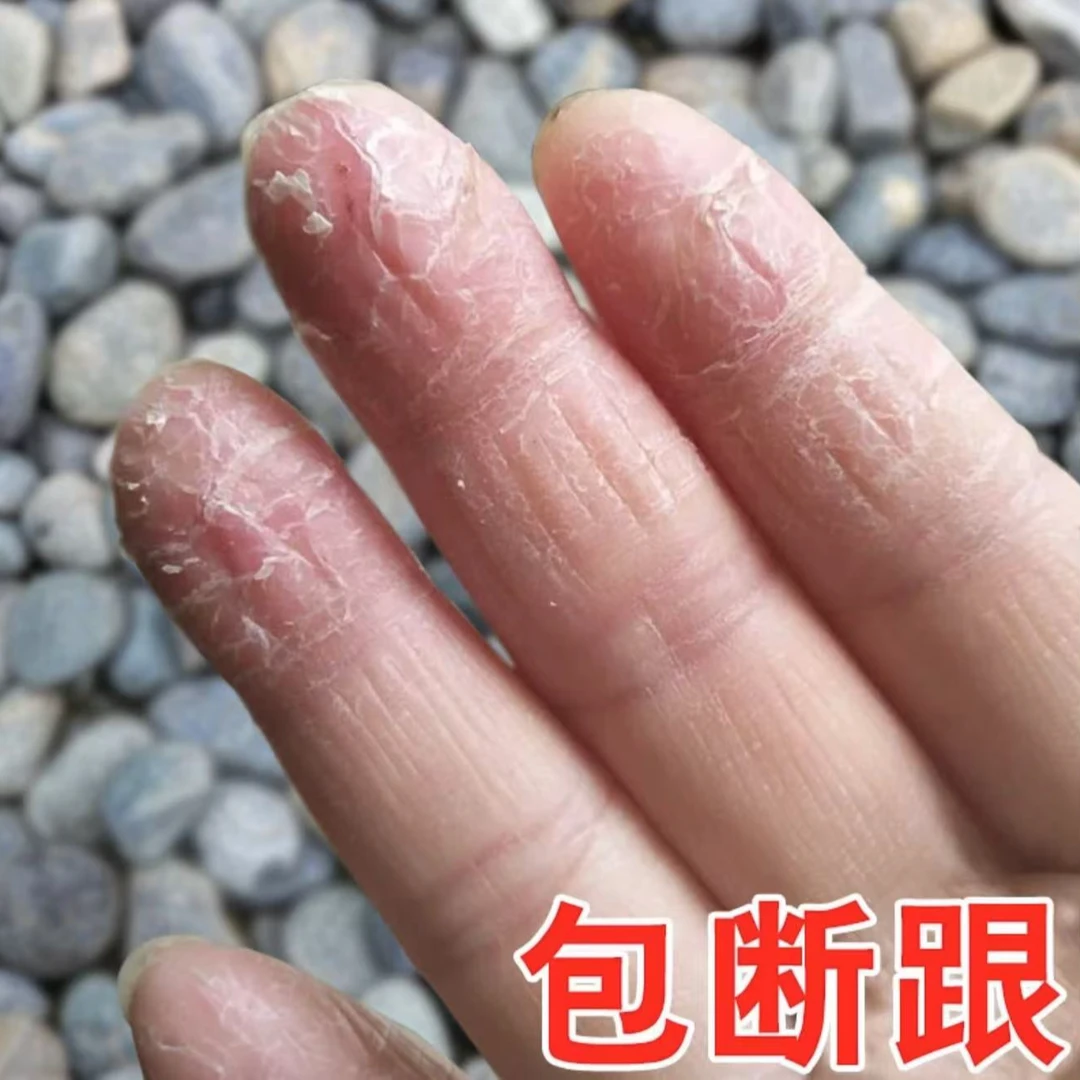 手指头脱皮起干皮手干裂手掌心脱皮起硬皮手足脱皮变硬外用软膏