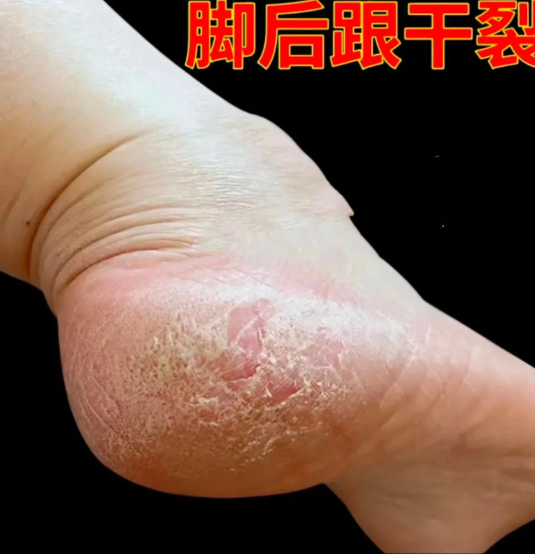 脚后跟干裂粗糙脚底起皮脚痒脚后跟脱皮脚臭抑菌止痒软膏季节性