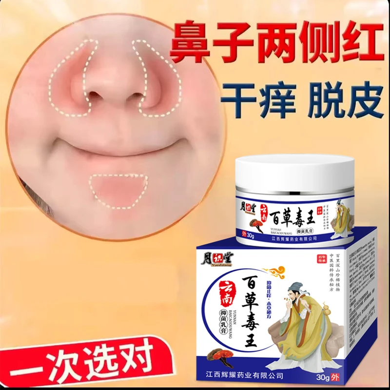 子两边泛红鼻翼两侧发红干燥起皮护理皮肤红痒干燥草本清洁舒适膏