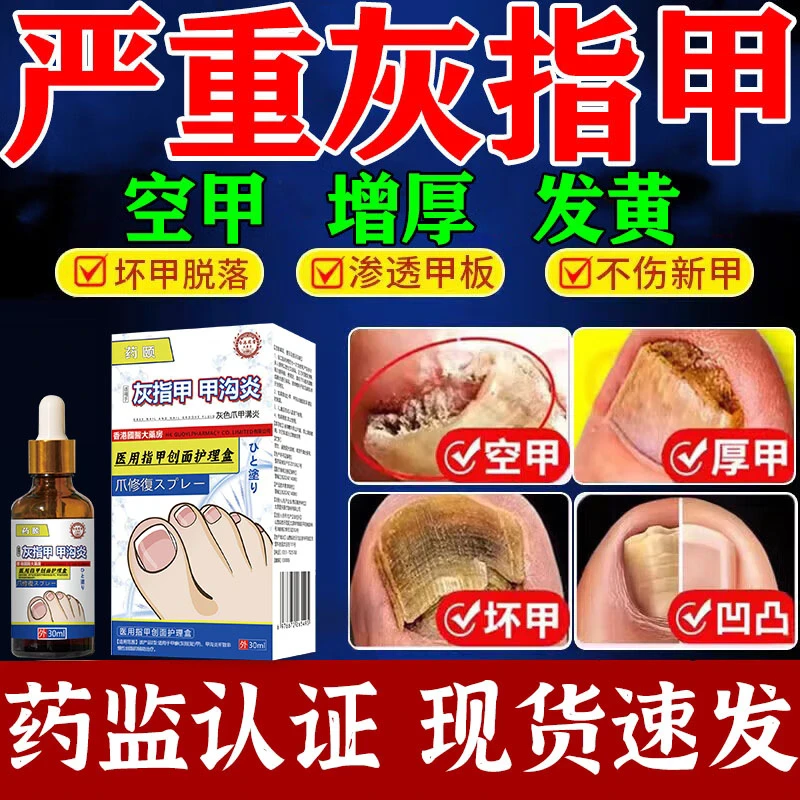 治疗灰指甲修复液指趾甲因细菌真菌感染增厚分层浑浊翘起脱落变色变黄易碎空甲等不适人群指趾甲曲延康医用指甲创面护理盒