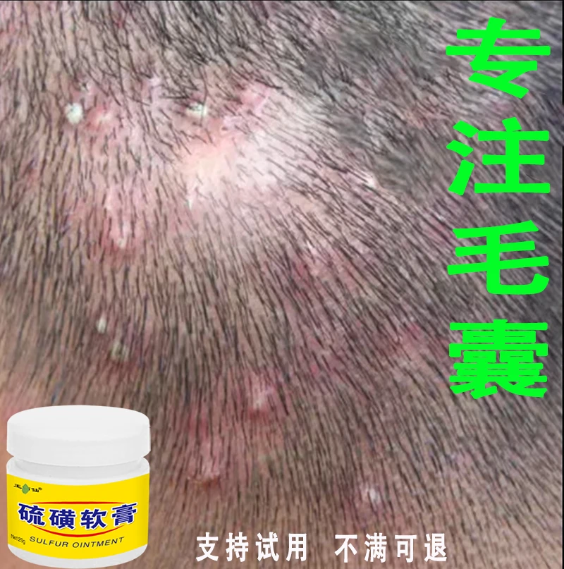 专注毛囊头皮瘙痒结痂大块白色头皮屑疙瘩头皮外用膏草本萃取舒缓