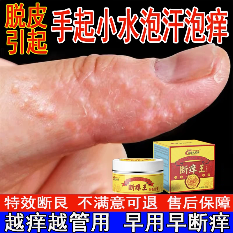 王真菌引起的手脚起小水泡痒脚趾脱皮汗泡痒干痒裂专用正品特效药