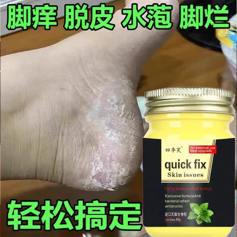 【正品】脚臭止痒烂脚神器抑菌止痒膏烂脚丫脱皮水泡脚趾缝烂痒专用