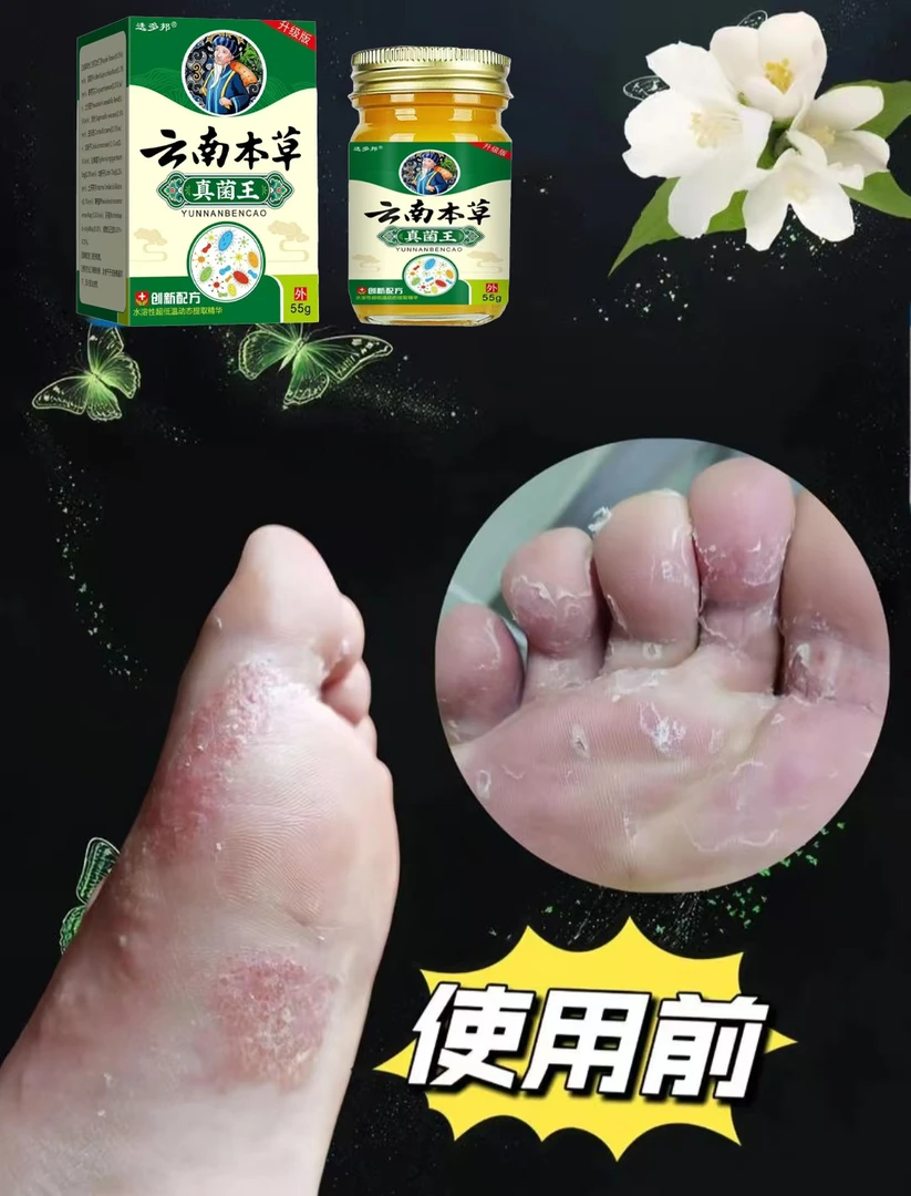 云南真菌王植物萃取外用皮肤抑菌止痒适用于脚臭脚痒脚脱皮
