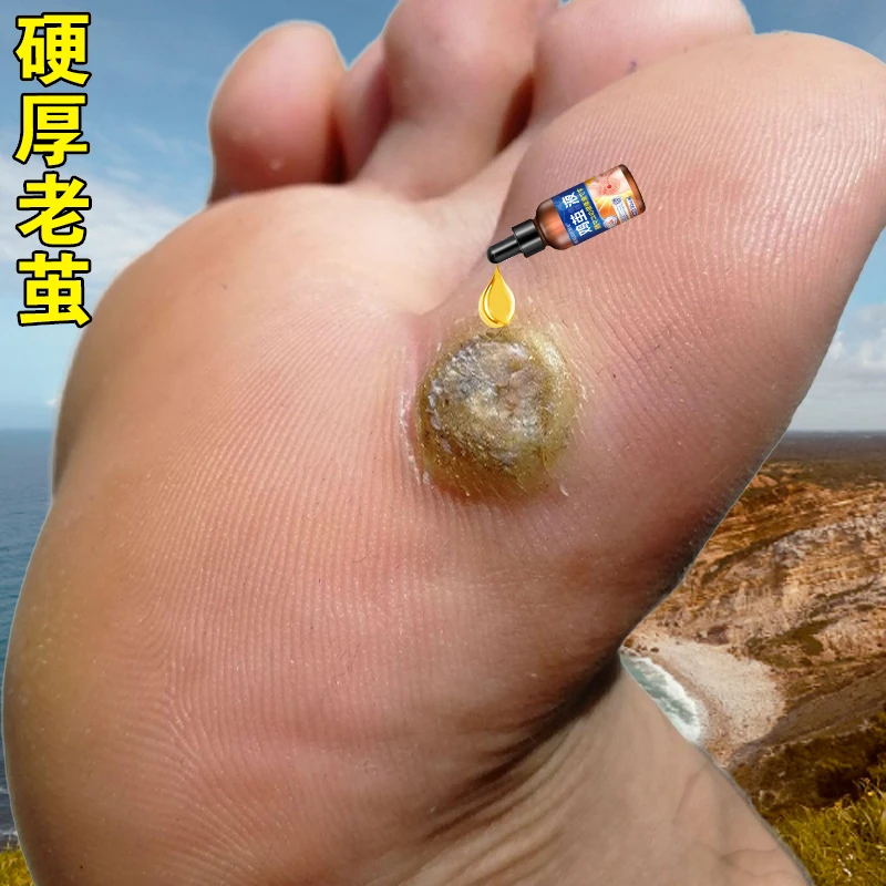 脚钉去除液去老茧神器手脚上脚趾厚皮茧脚底脚垫去老茧软化剂m