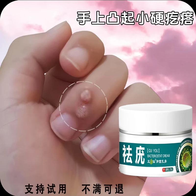 一款很牛的皮肤手上脚上袪尤膏草本萃取温和抑菌袪尤乳膏