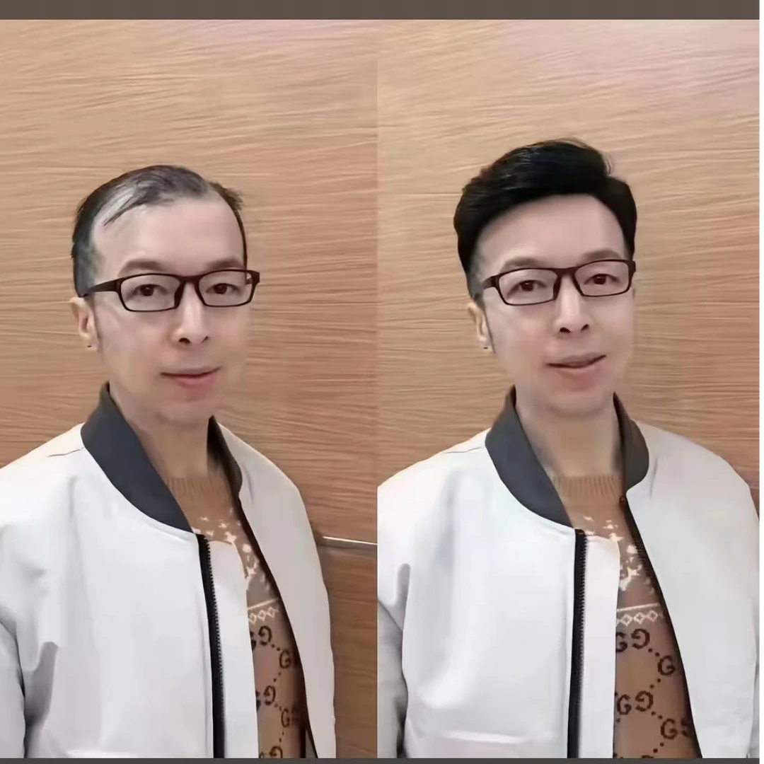 全递针定制假发360度无死角