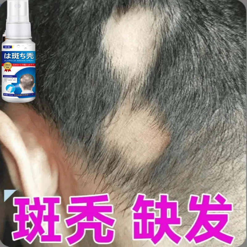 鬼剃头谢顶秃顶防脱突发斑性秃营养液特效鬼剃头特育发效生姜发根