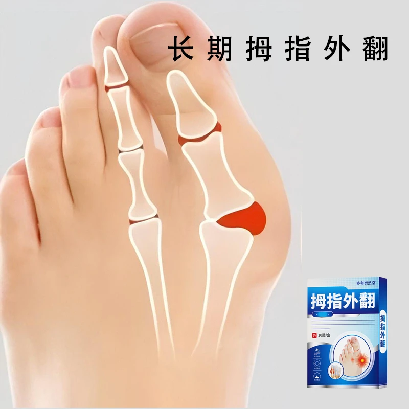 拇指外翻鼓包贴大脚骨突出拇外翻重叠脚指头挤压酸草本温和贴