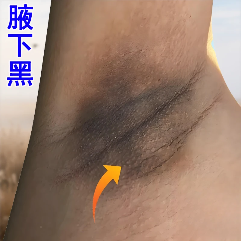 黑棘皮脖子黑腋下黑大腿内侧屁股黑坐印全身关节黑色素沉着乳膏G