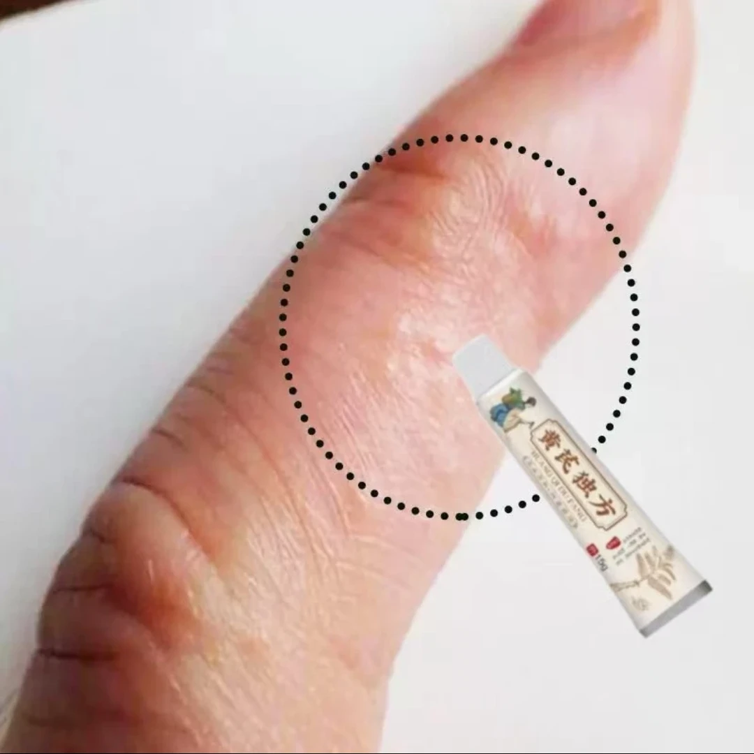 手上长水泡痒抑菌乳膏手指头长水泡珍脚上起水泡痒手上起小水泡痒