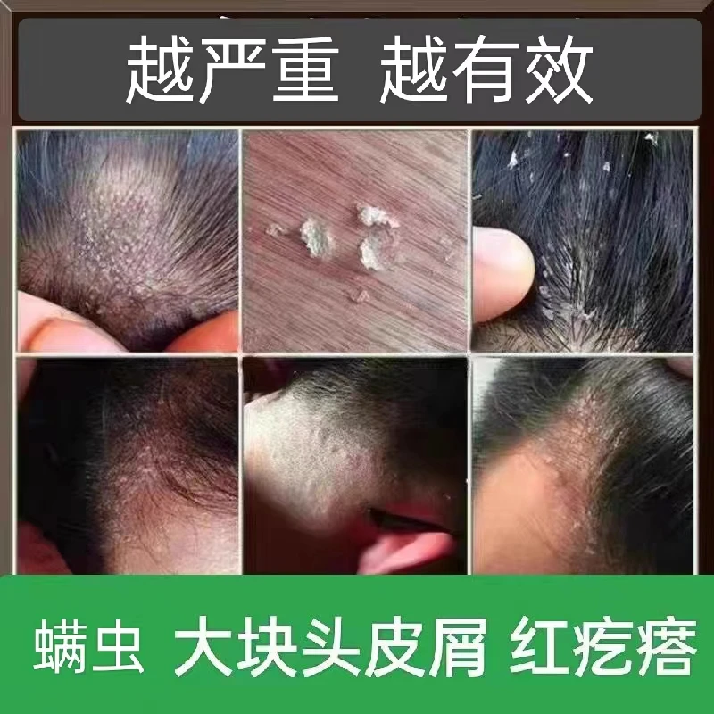 大块头皮屑止痒去头屑多红疙瘩抑菌乳植物草本去螨虫非洗头发水膏
