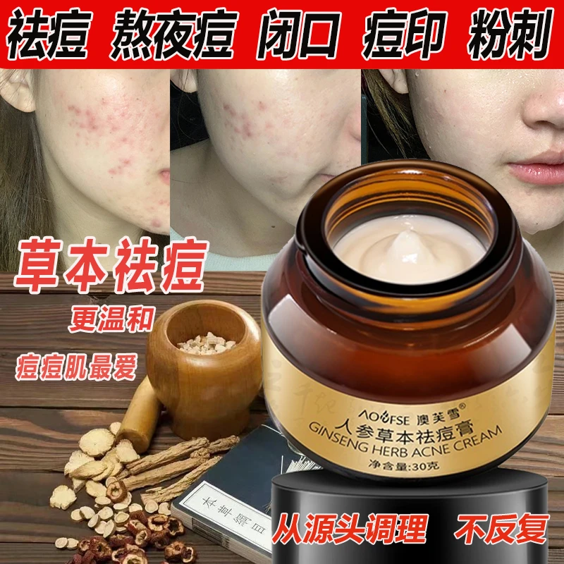 祛痘膏淡化痘印痘坑痘疤青春痘学生男女去黑头去闭口粉刺祛痘面霜