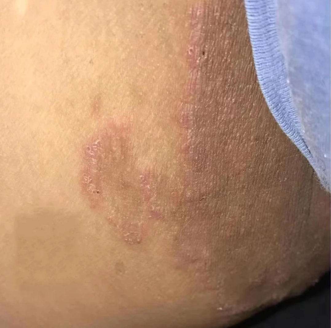 男女大腿两侧发黑内侧大腿发痒红大腿根部疙瘩疼痛痒止痒抑菌乳膏