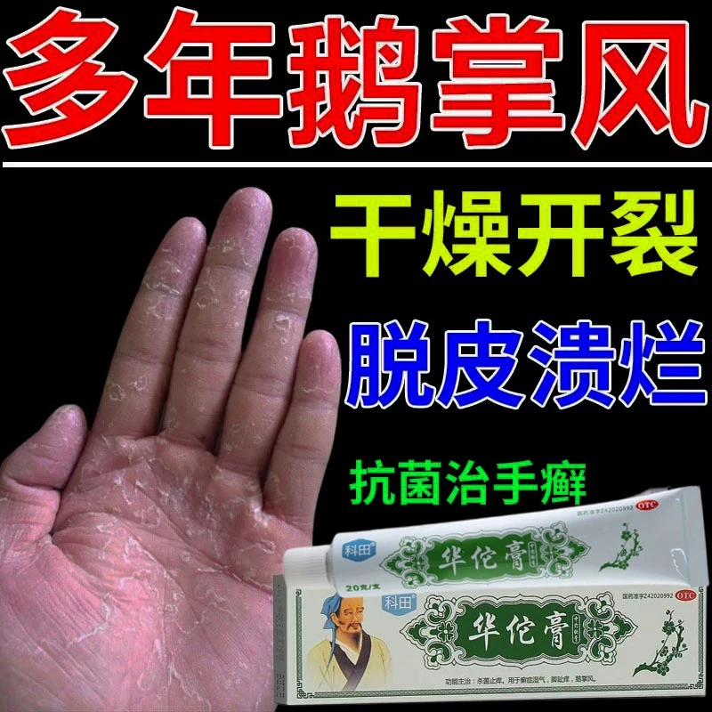 科田治鹅掌风药膏手癣症皮肤真菌感染杀菌止痒 华佗膏20g手癣真菌感染药膏脱皮开裂止痒手脱皮药手癣脱皮干裂手脱皮用什么药