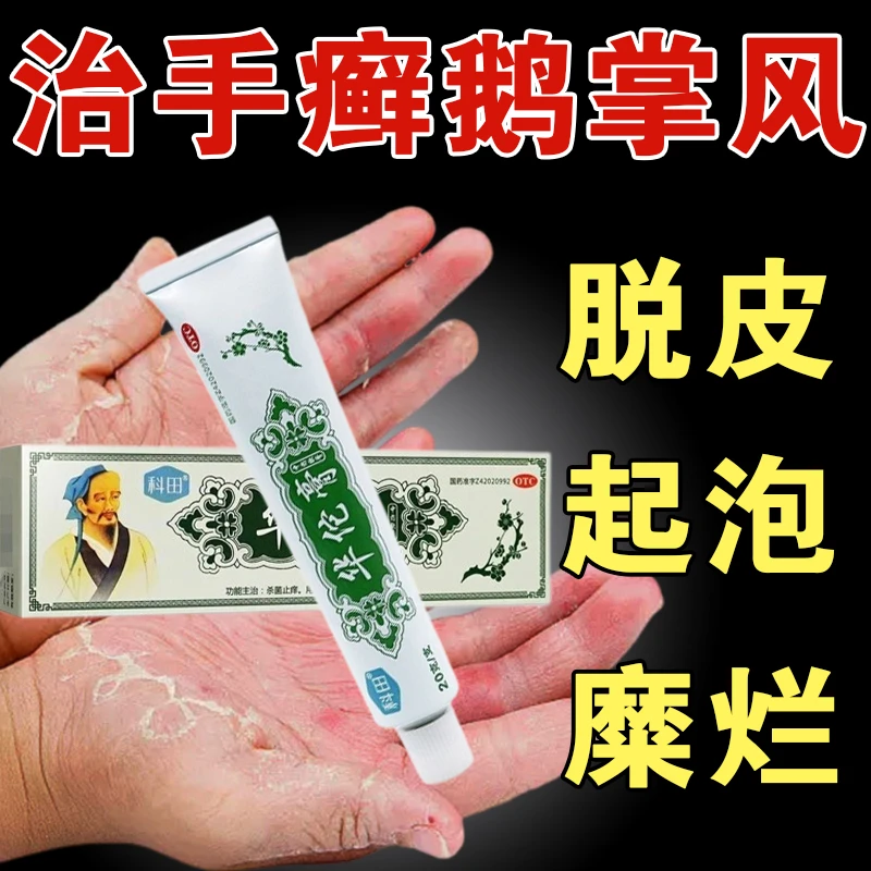 治鹅掌风药膏手癣症皮肤真菌感染杀菌止痒 华佗膏20g 科田瘙痒脱皮开裂止痒手脱皮药手癣脱皮干裂手脱皮真菌感染皮肤用药