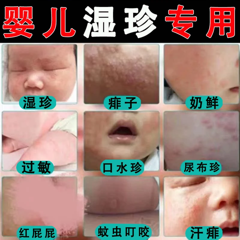 宝宝婴幼儿专用口水珍淹脖子红屁屁无激素抑菌止痒草本外用抑菌膏