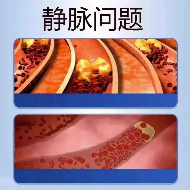 【官方正品】远红外静脉型凝治胶疗正品保障抑菌草本萃取温和