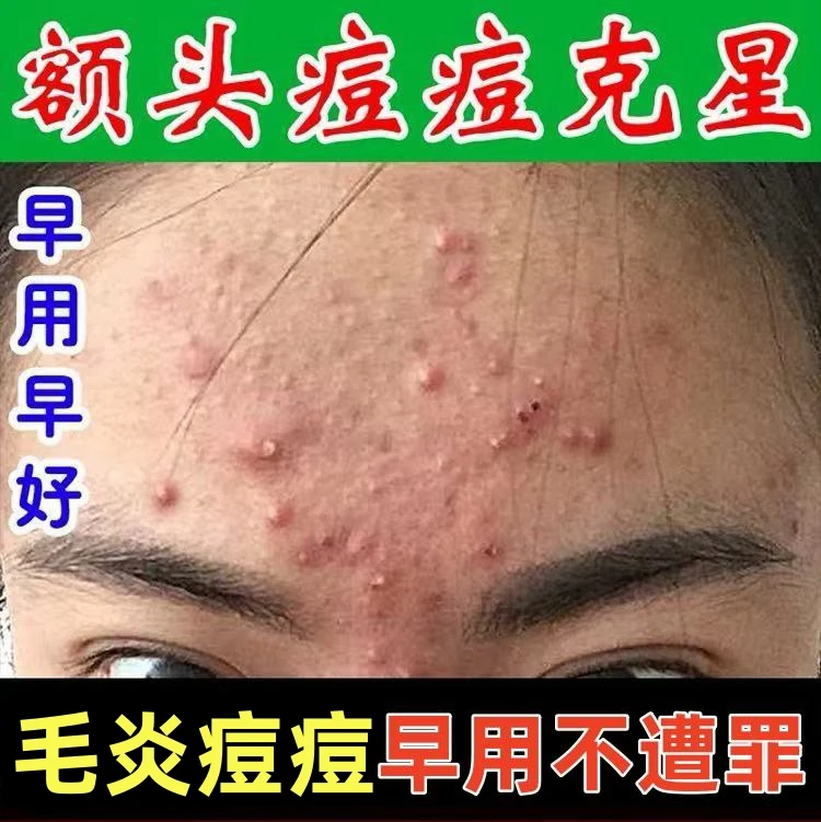 额头痘痘下巴痘痘脸上反复长痘痘男女通用毛炎清软膏