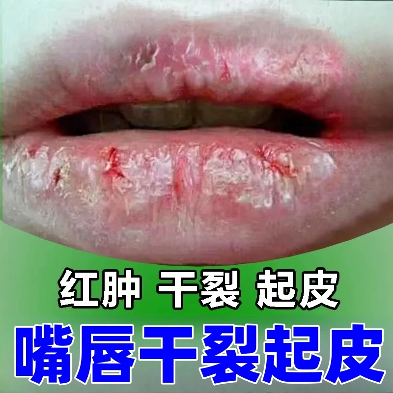 儿童润唇修复膏嘴唇起皮干裂起泡上火外用滋润保湿软膏