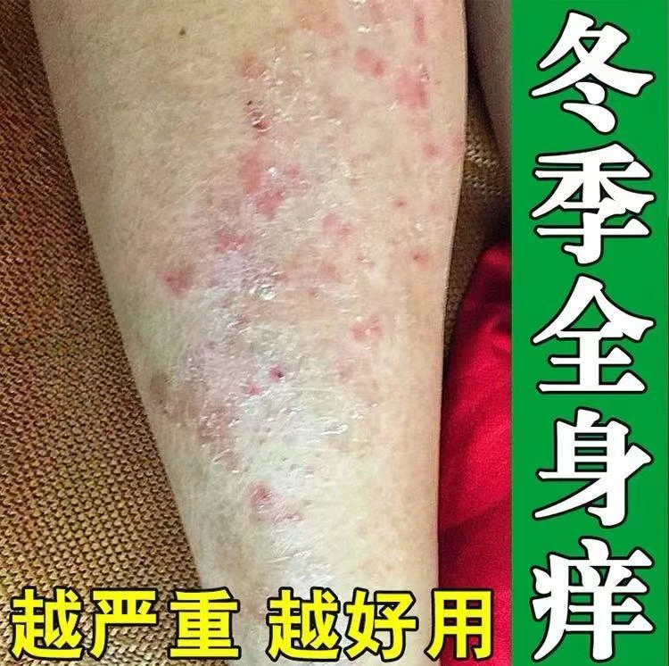秋冬季皮肤干燥痒全身腿上胳膊后背皮肤干燥起皮痒百草肤毒清软膏